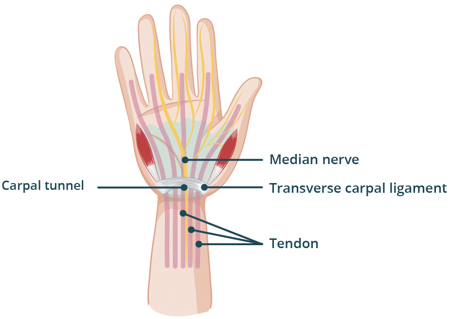 Carpal Tunnel Syndrome