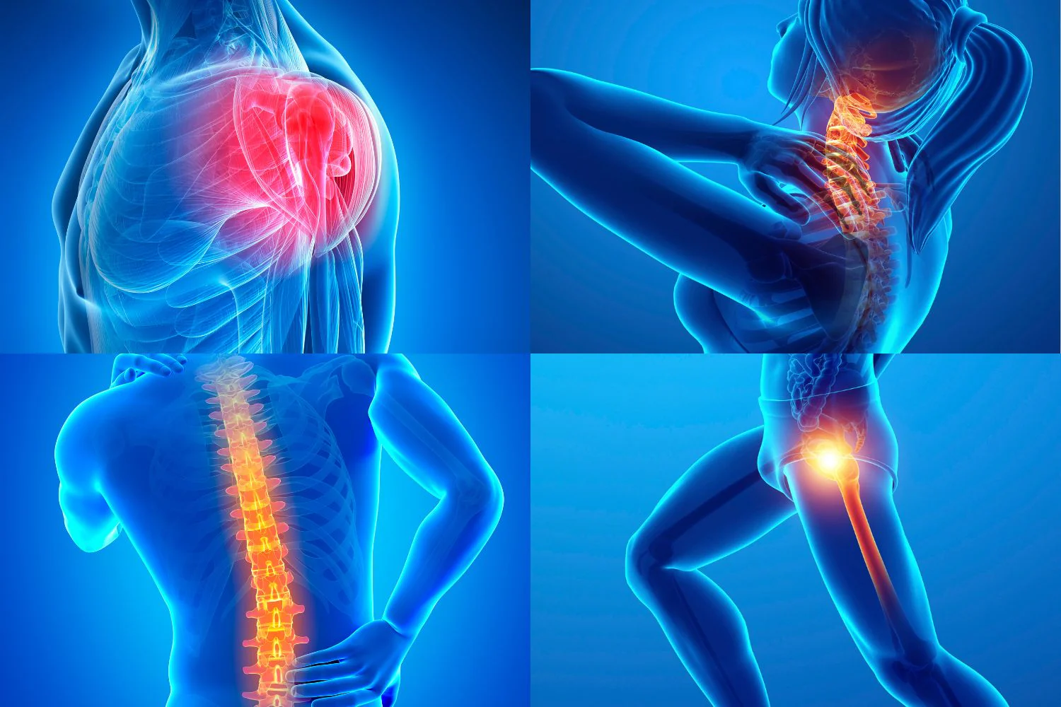Fibromyalgia Syndrome