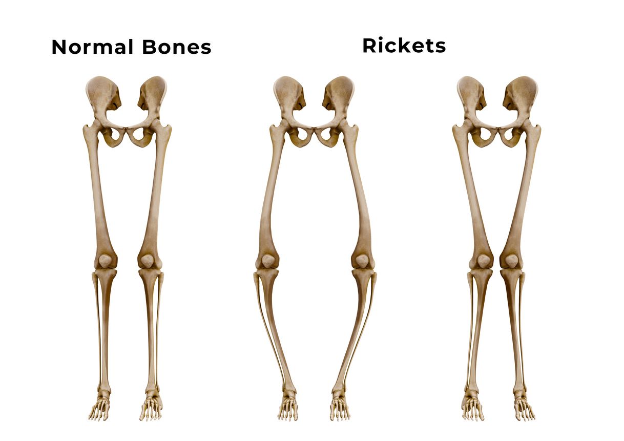 rakitis