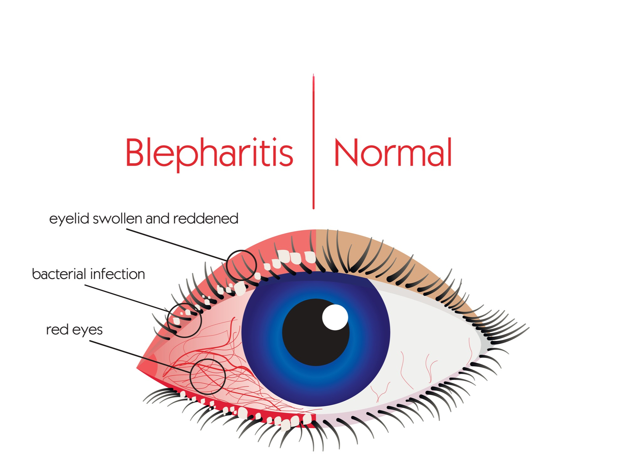 Blefaritis