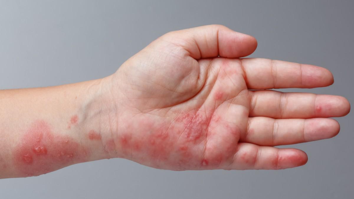 Herpes Simpleks: Cara Pencegahan Sehari-hari untuk Mengurangi Risiko Penularan