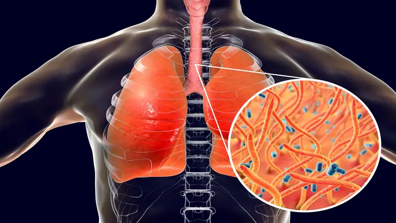 Pertusis Batuk dan Gejala Khas yang Harus Diwaspadai Orang Tua