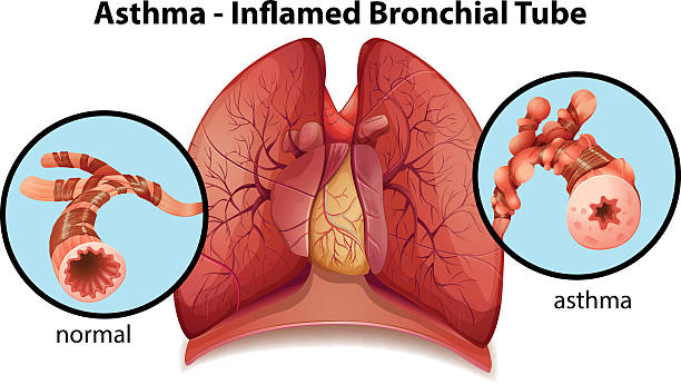 Asthma Bronkial