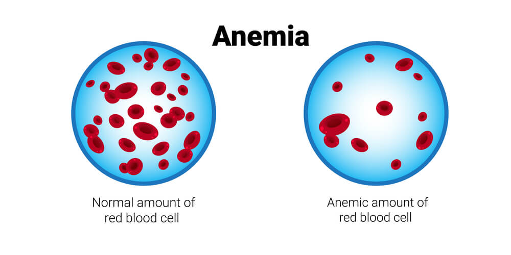 Anemia Ringan