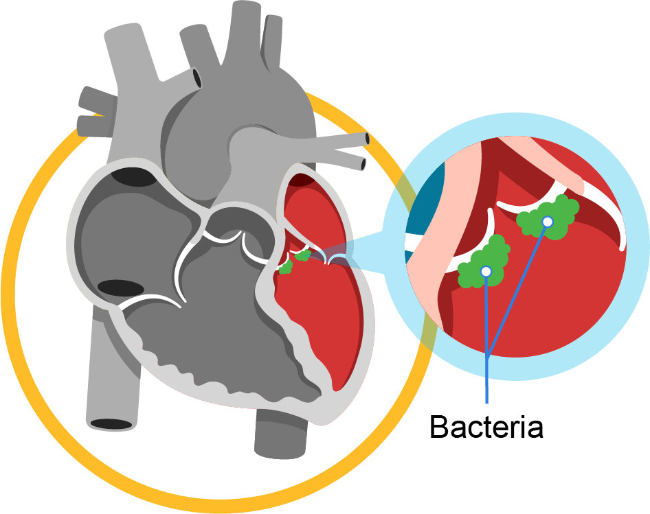 Endokarditis Jantung