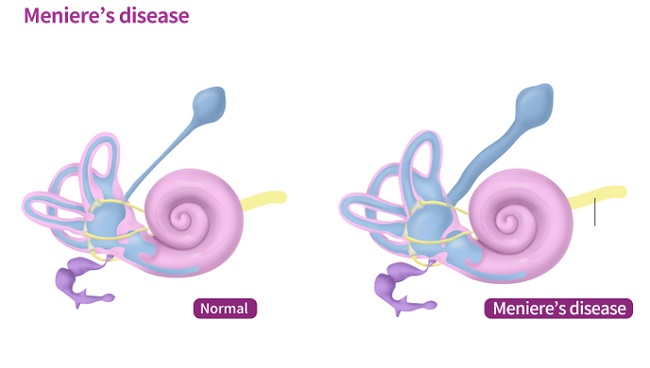 Meniere Telinga: Apa yang Harus Anda Ketahui Saat Vertigo Mendadak Terjadi