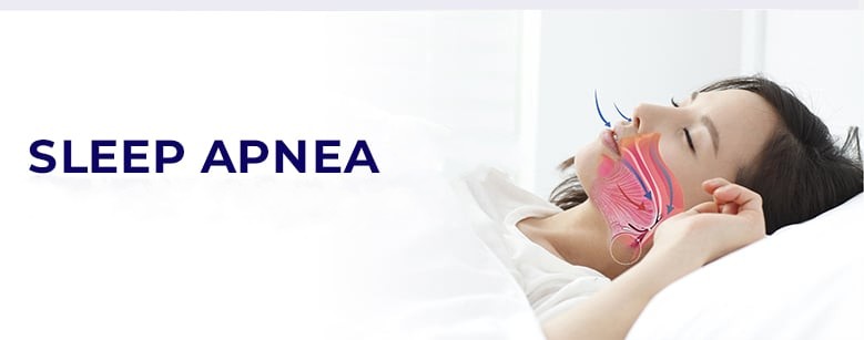 Sleep Apnea