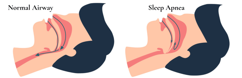 Sleep Apnea