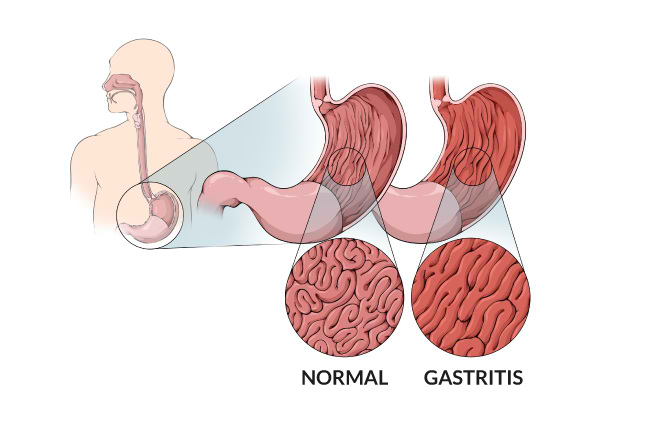 Gastritis: Gejala, Penyebab, dan Cara Mengelola Lambung