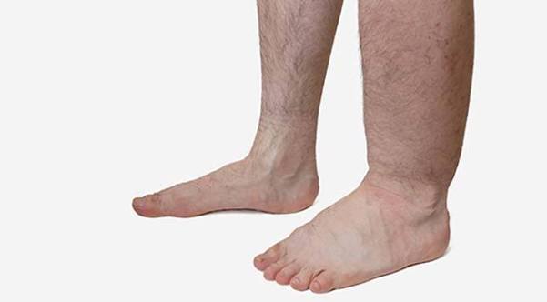 Filariasis Kronis
