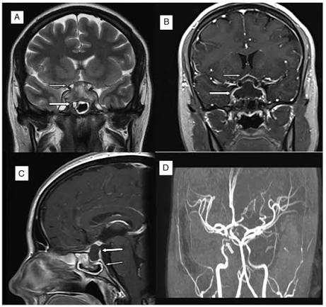Adenoma Hipofisis
