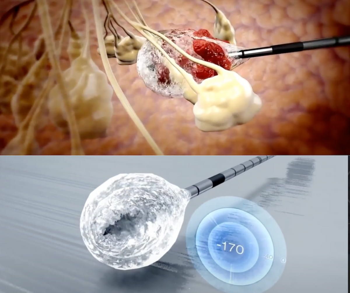 Cryoablation Tumor