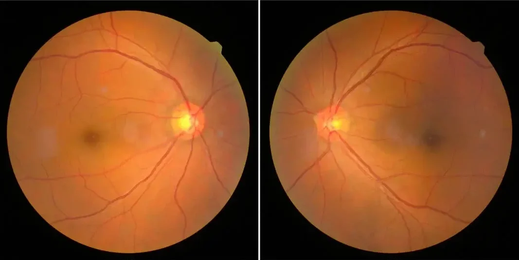 Amaurosis Fugax