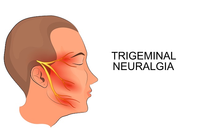 Neuralgia Trigeminal