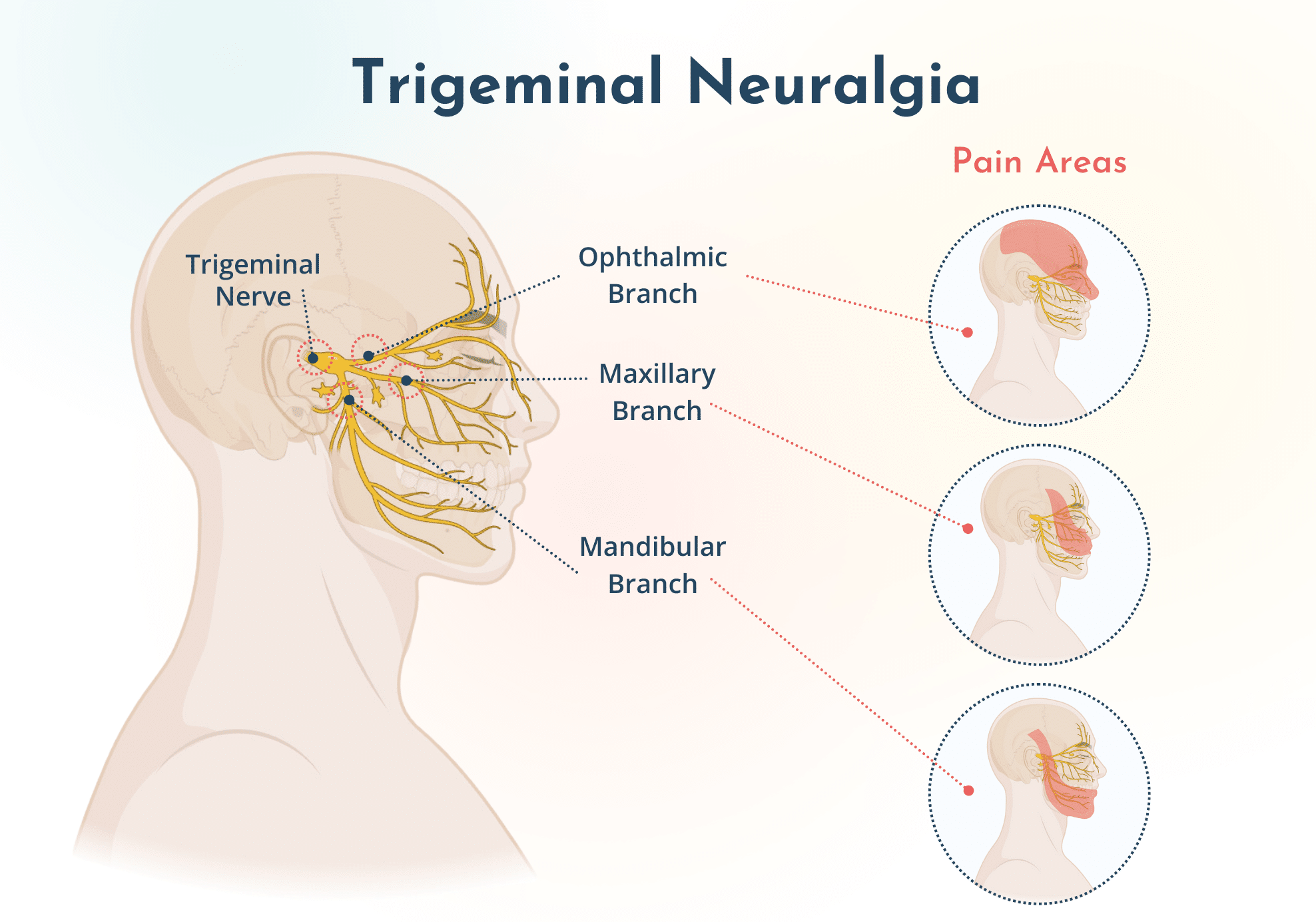 Neuralgia Trigeminal