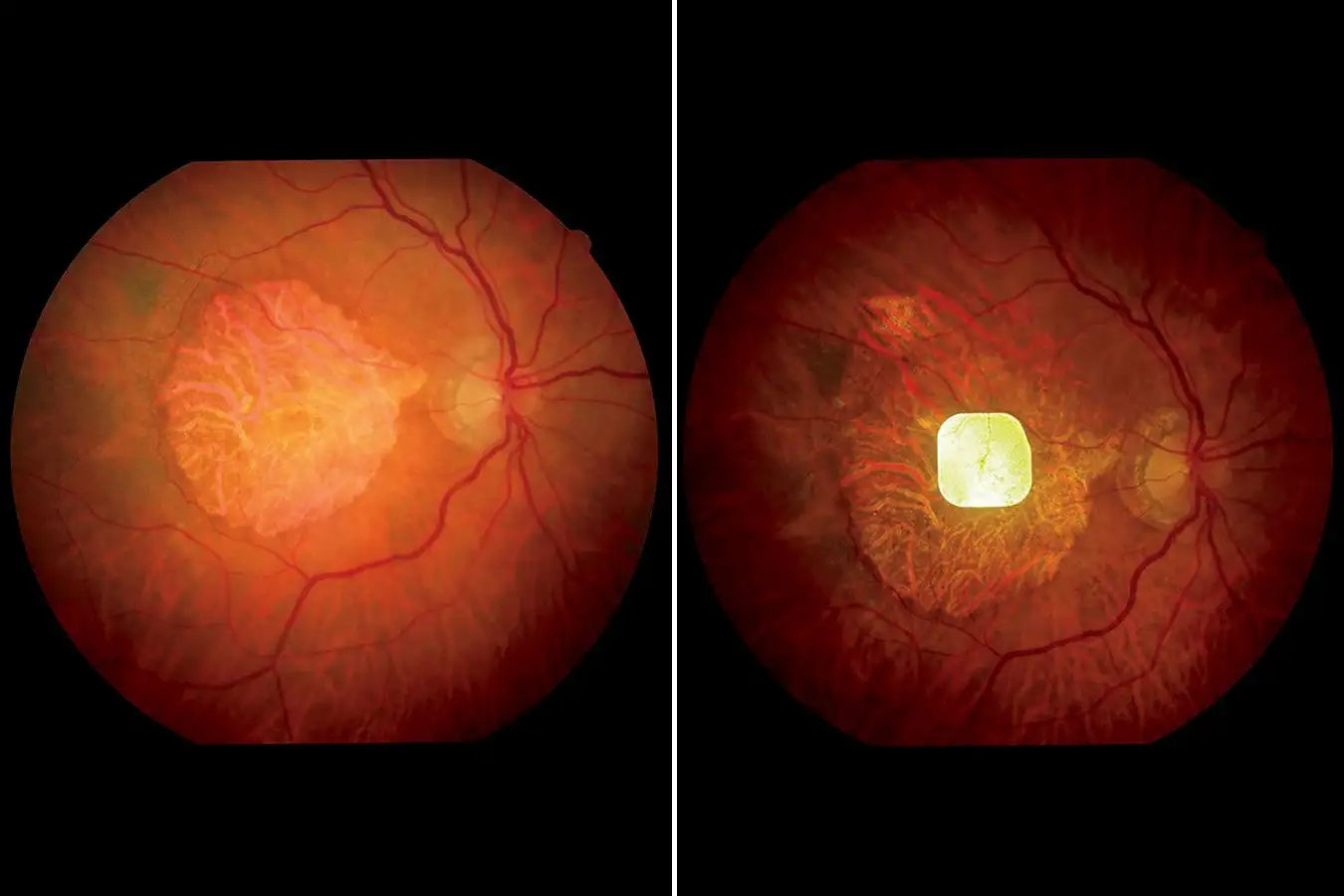 Implan Retina