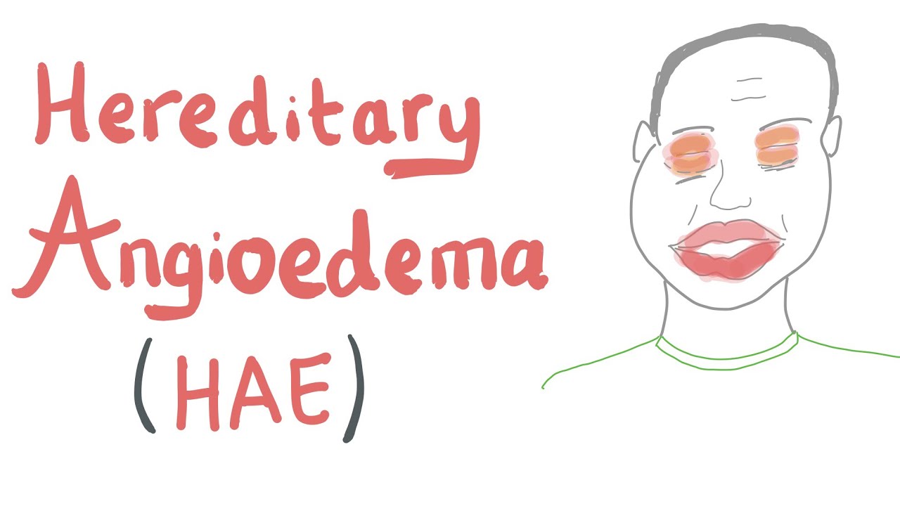 Hereditary Angioedema