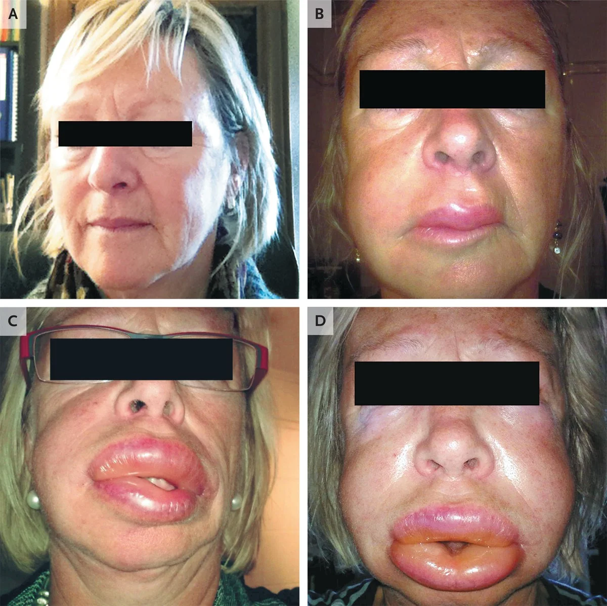 Hereditary Angioedema