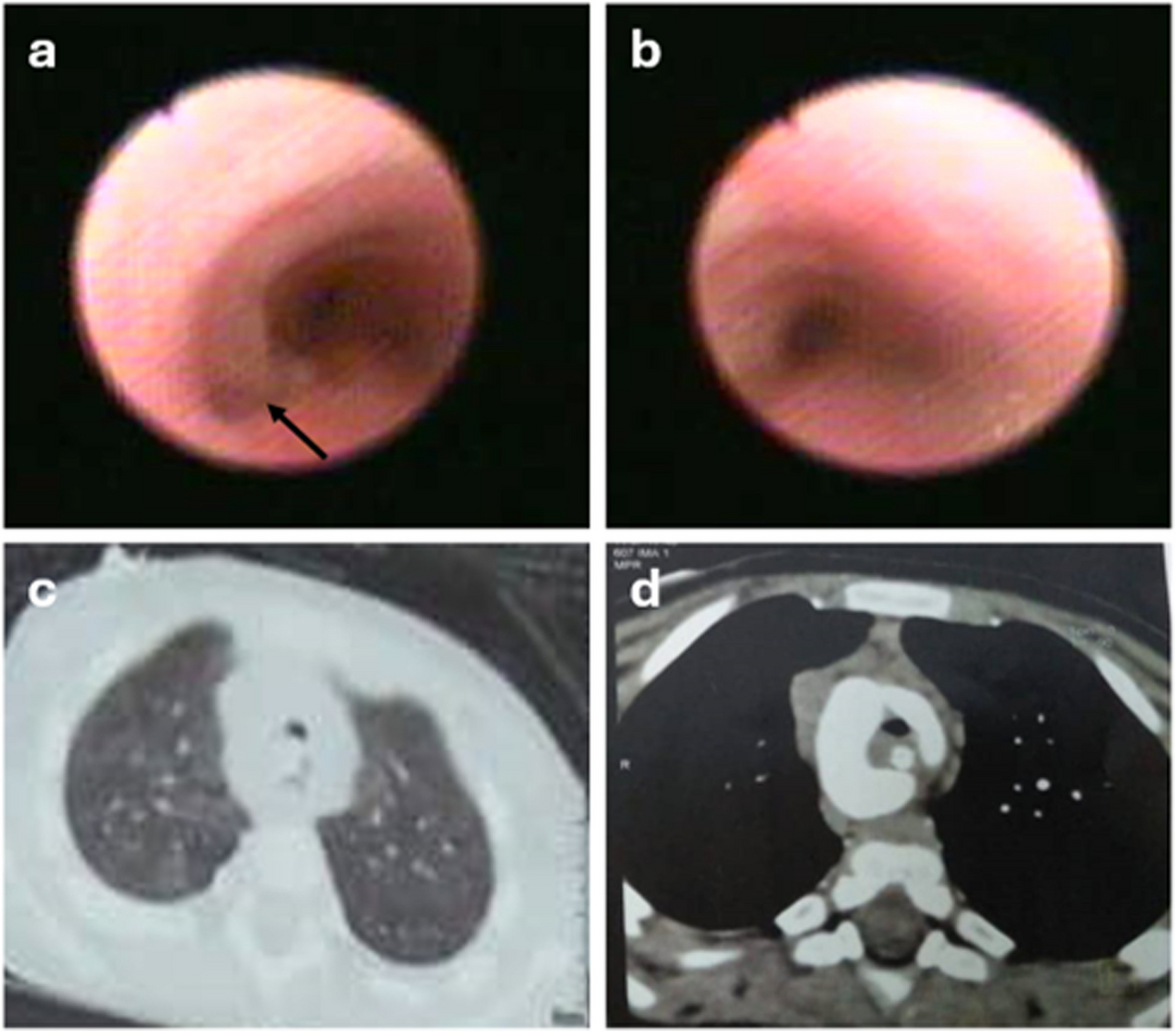 Tracheomalacia