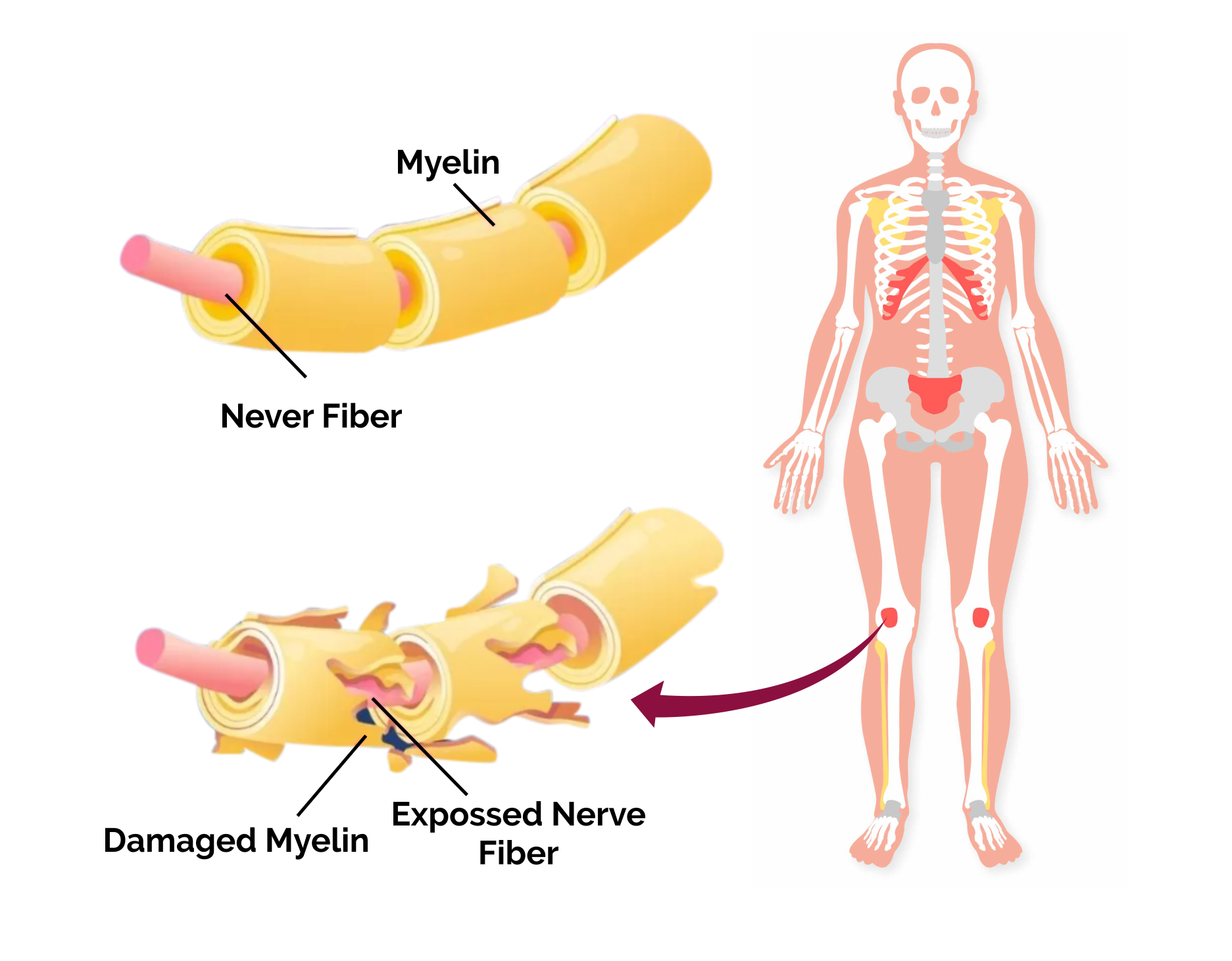 GBS Disease