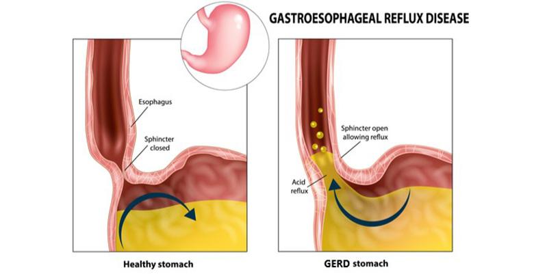Gastroesofagus