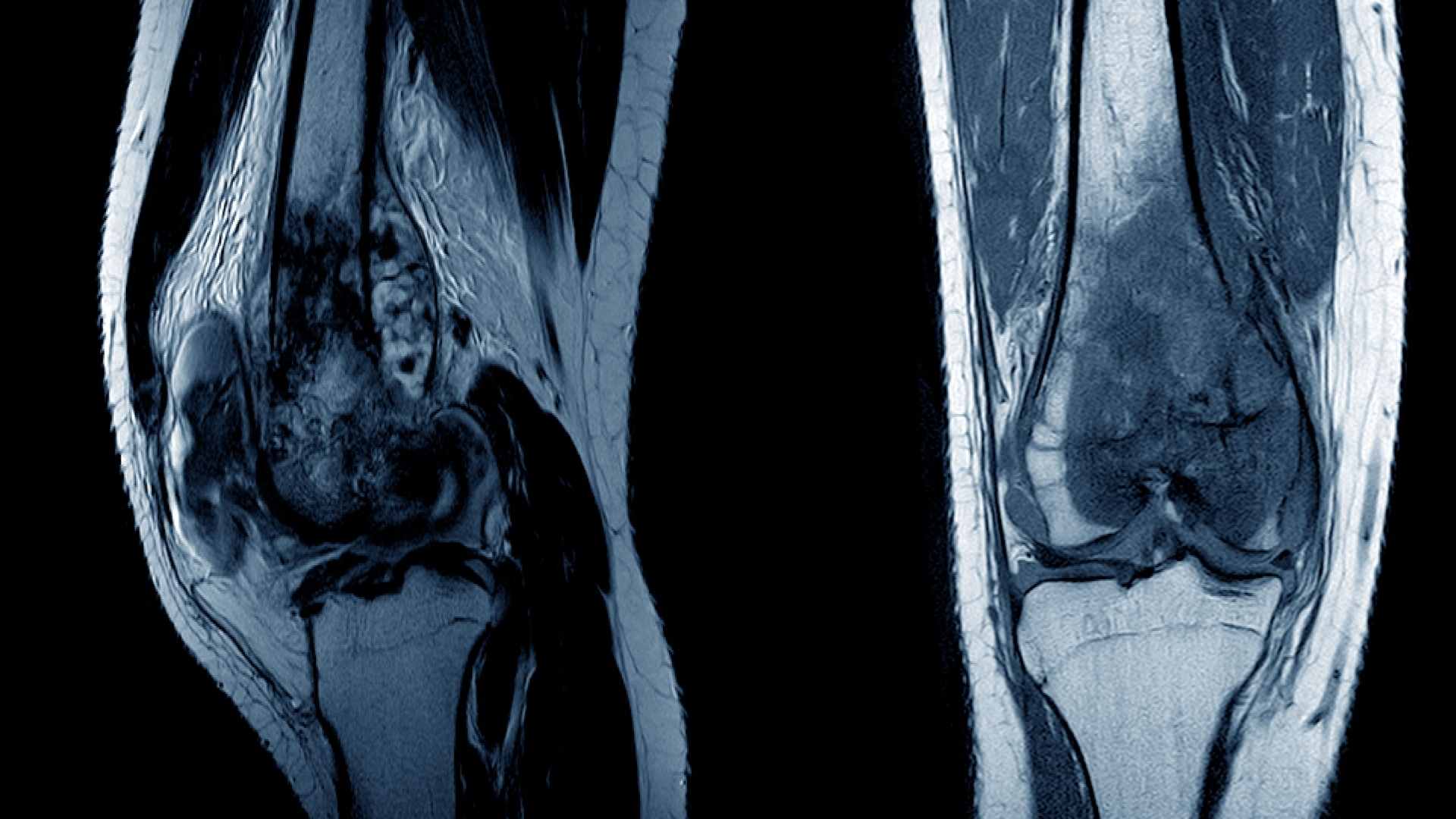Osteosarcoma