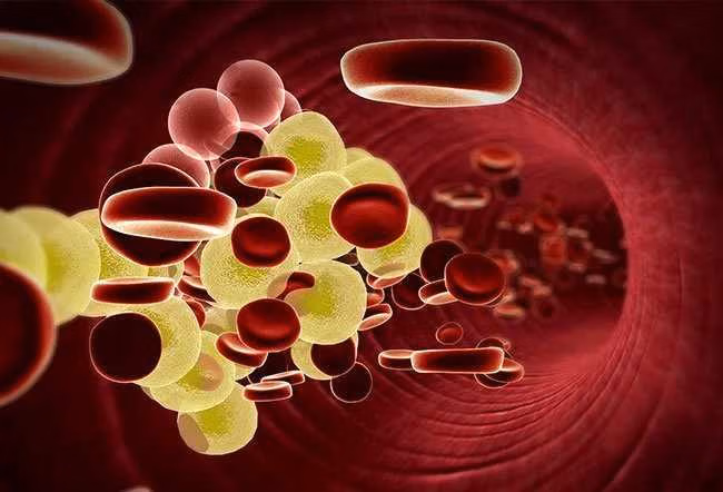 Hiperlipidemia Kronis
