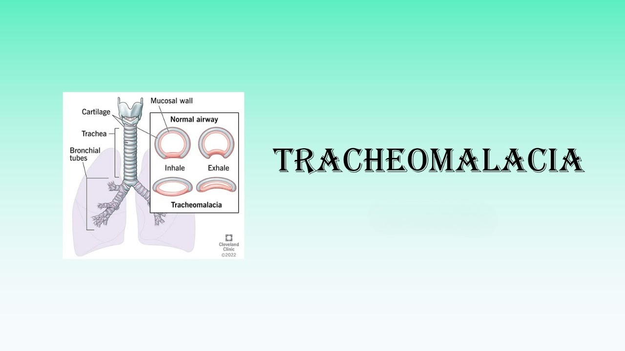 Tracheomalacia