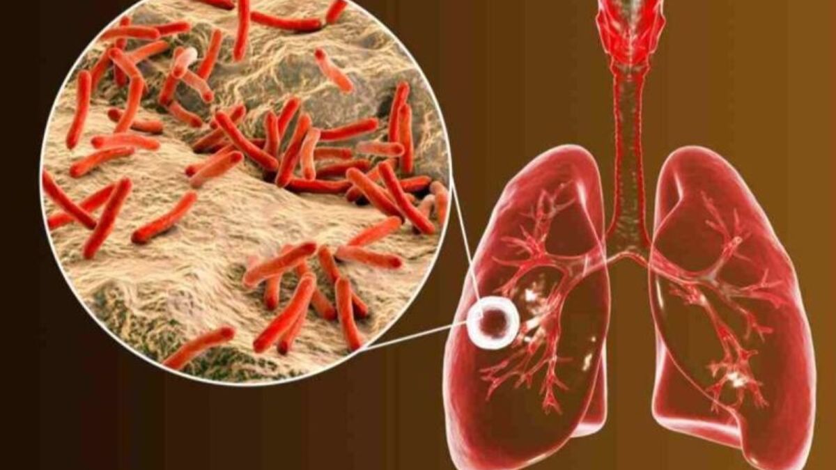 Tuberkulosis
