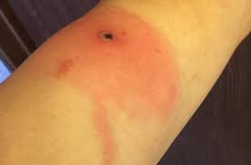 Borealpox Virus