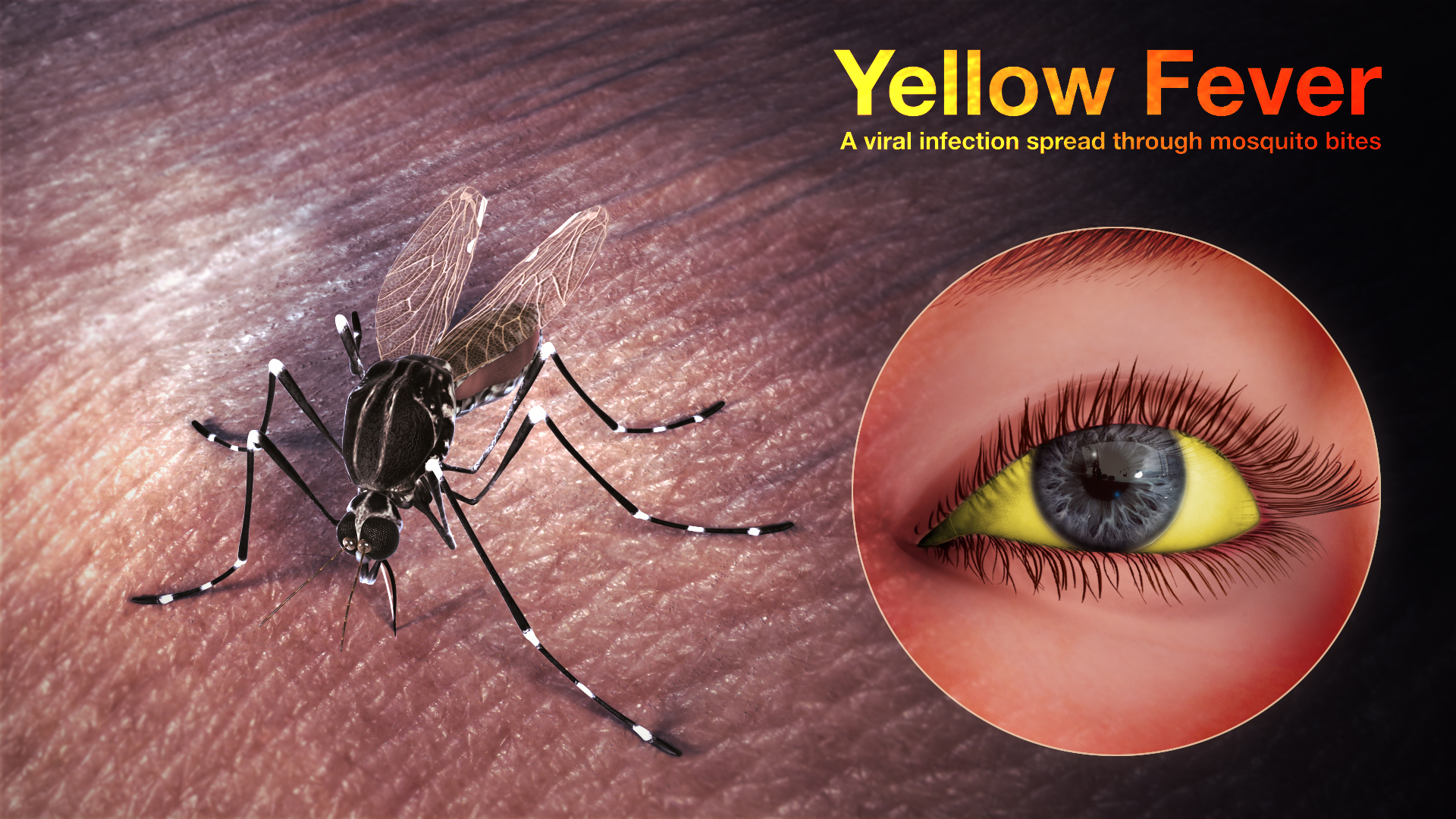Yellow fever