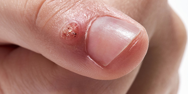Virus HPV
