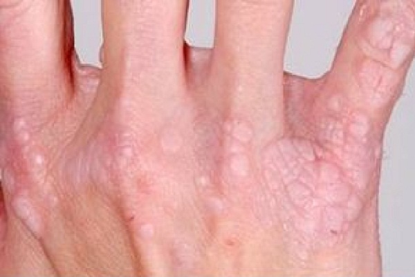 Virus HPV
