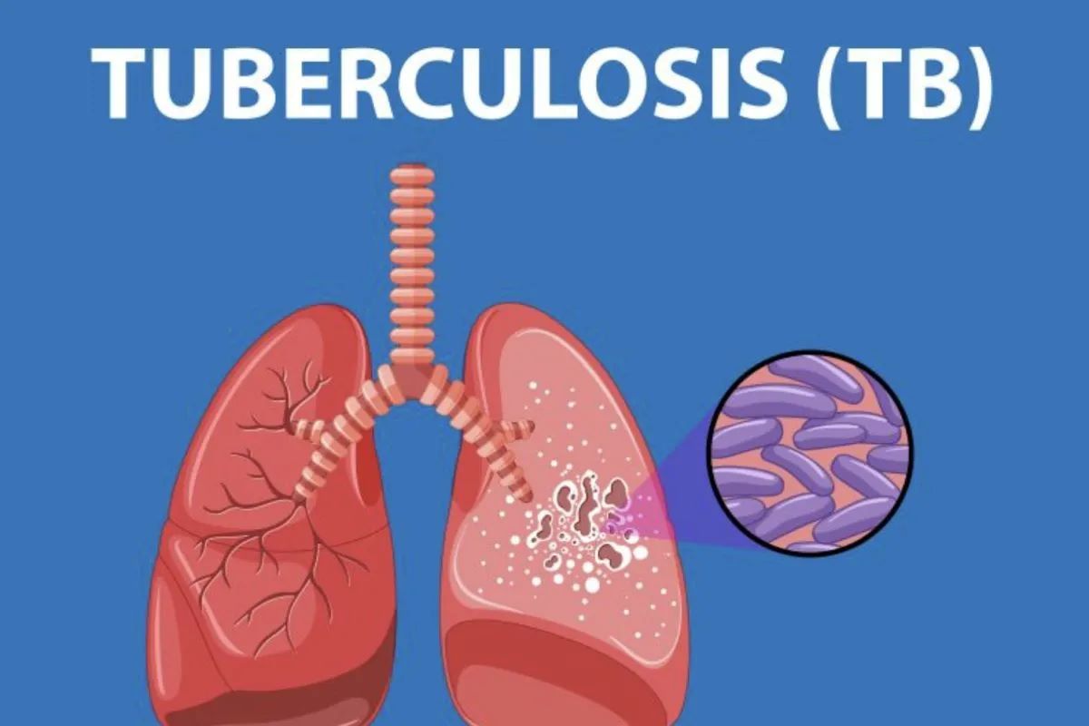 Tuberkulosis