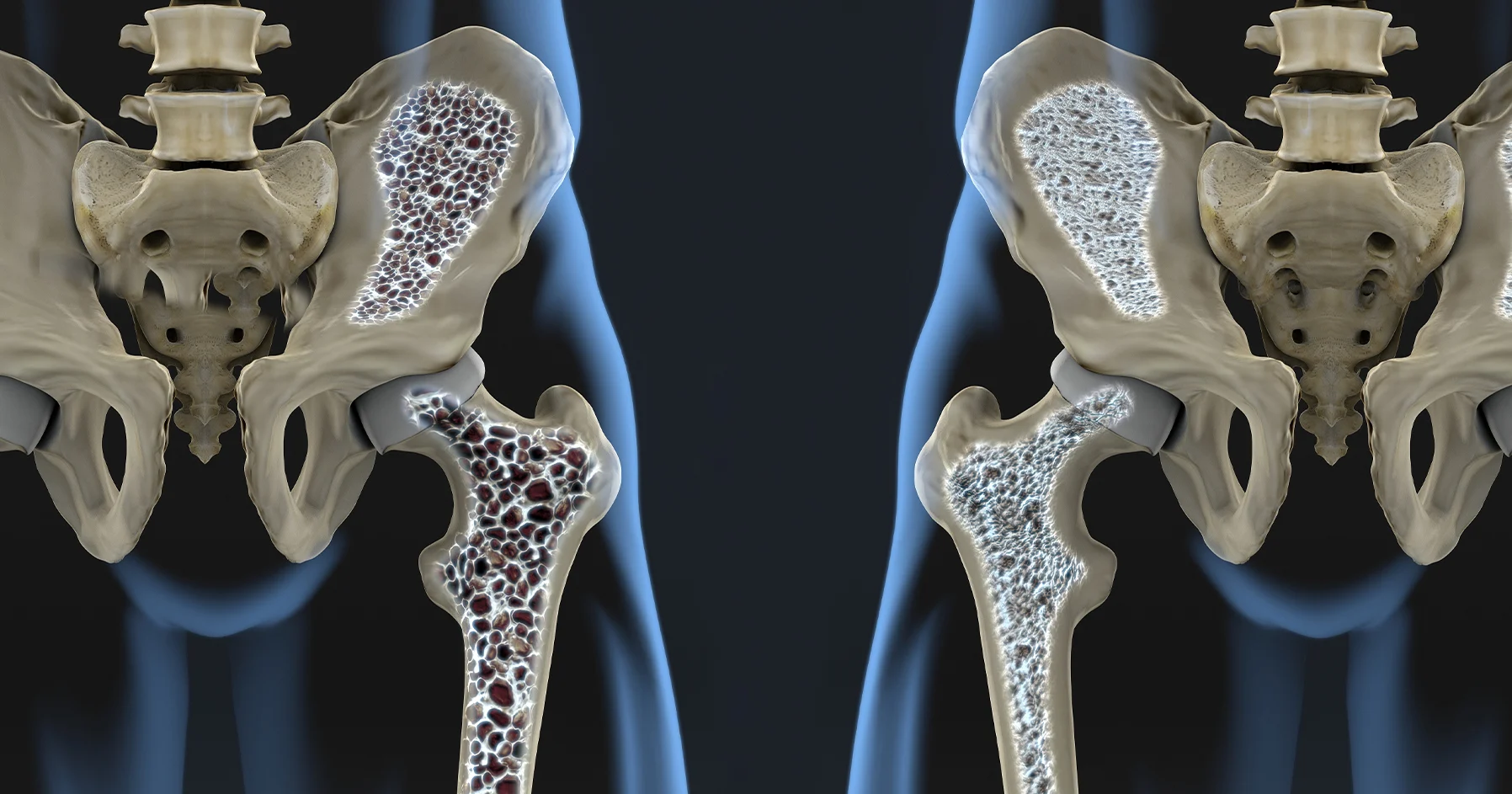 Osteoporosis pada Wanita: Risiko dan Penanganan yang Tepat