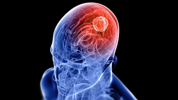 Tumor Otak dan Teknologi Medis Terkini untuk Pengobatannya