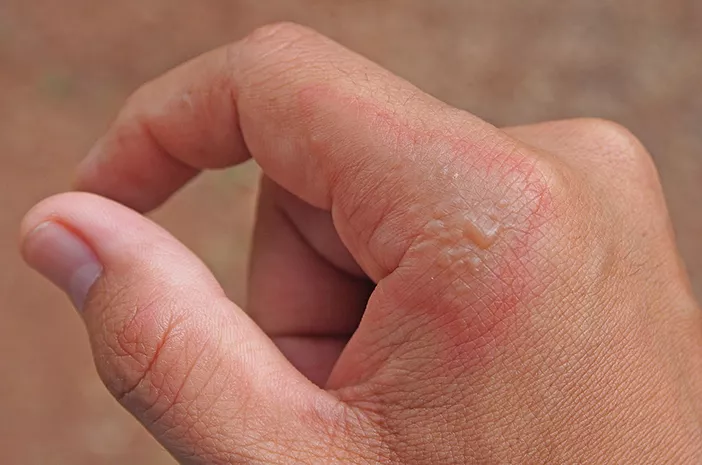Infeksi Impetigo