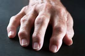 Rheumatoid Arthritis