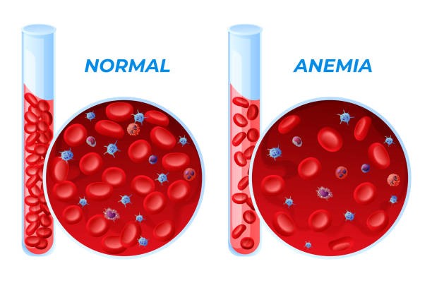 Anemia Defisiensi Besi