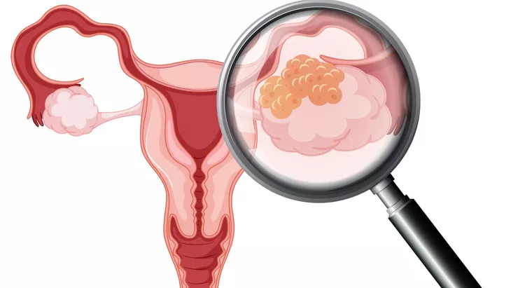 Kanker Serviks: Penyebab, Gejala, dan Cara Pencegahan yang Wajib Diketahui Wanita