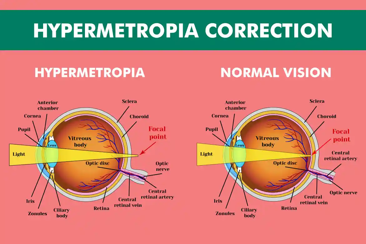Hipermetropi