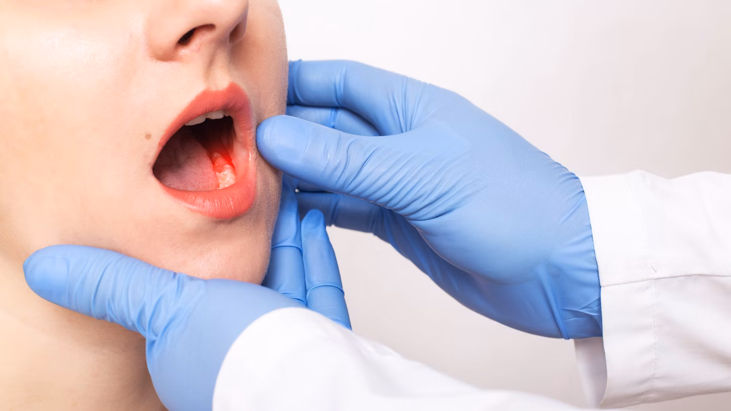 Periodontitis agresif