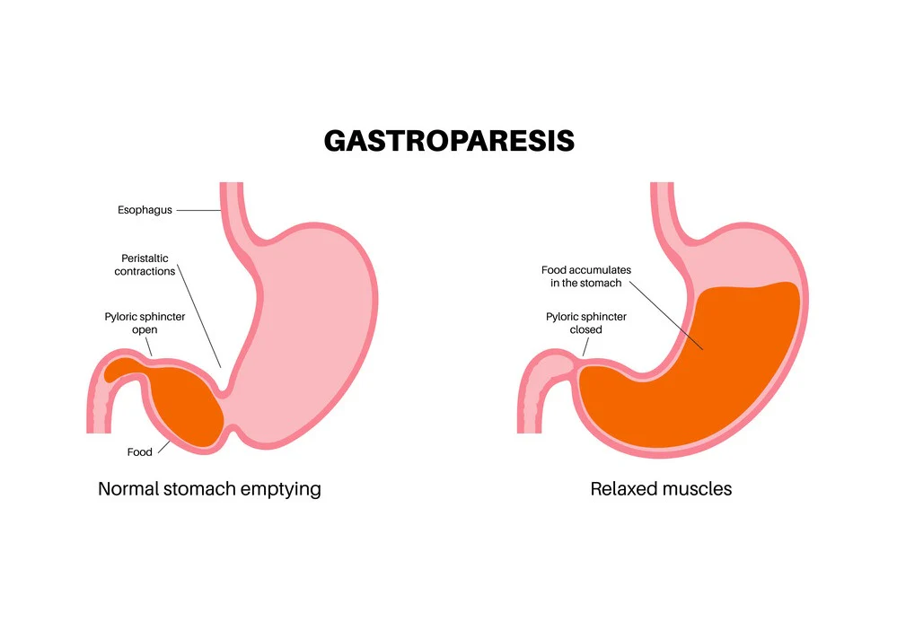 Gastroparesis