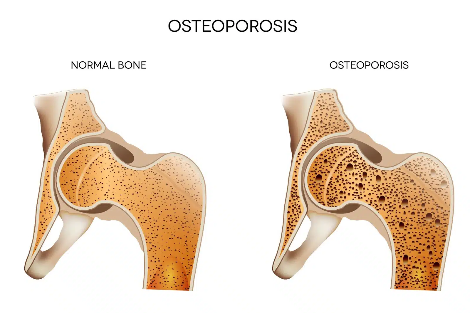 Pencegahan Osteoporosis