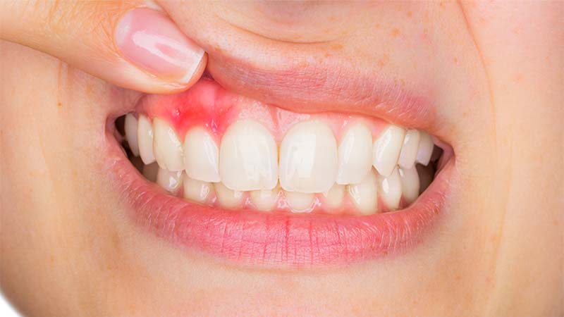 Periodontitis agresif