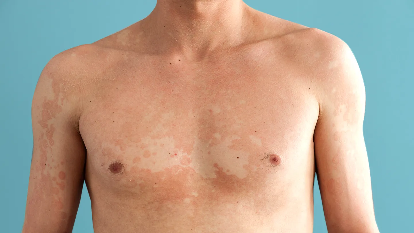 Tinea Versicolor