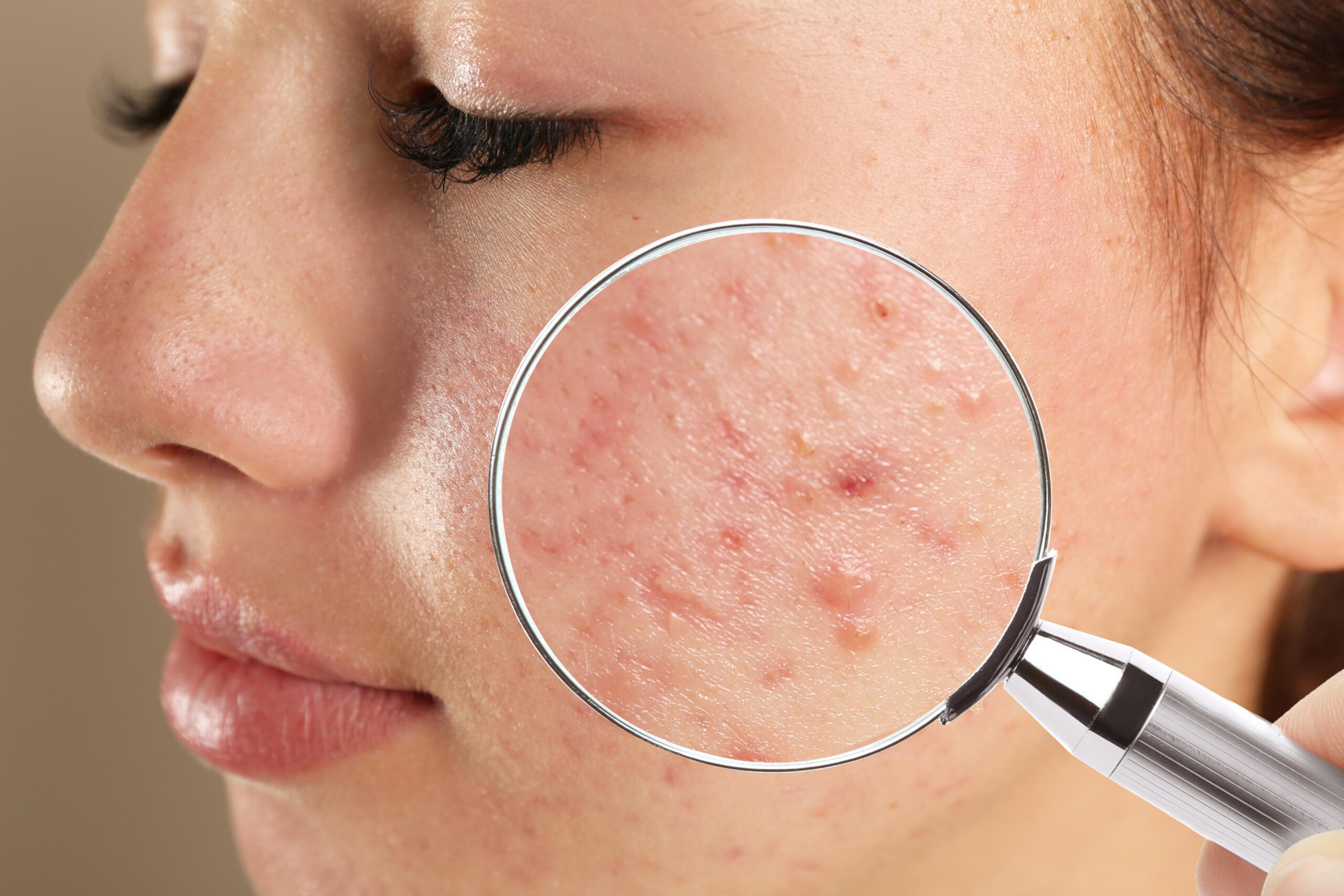 Acne Vulgaris