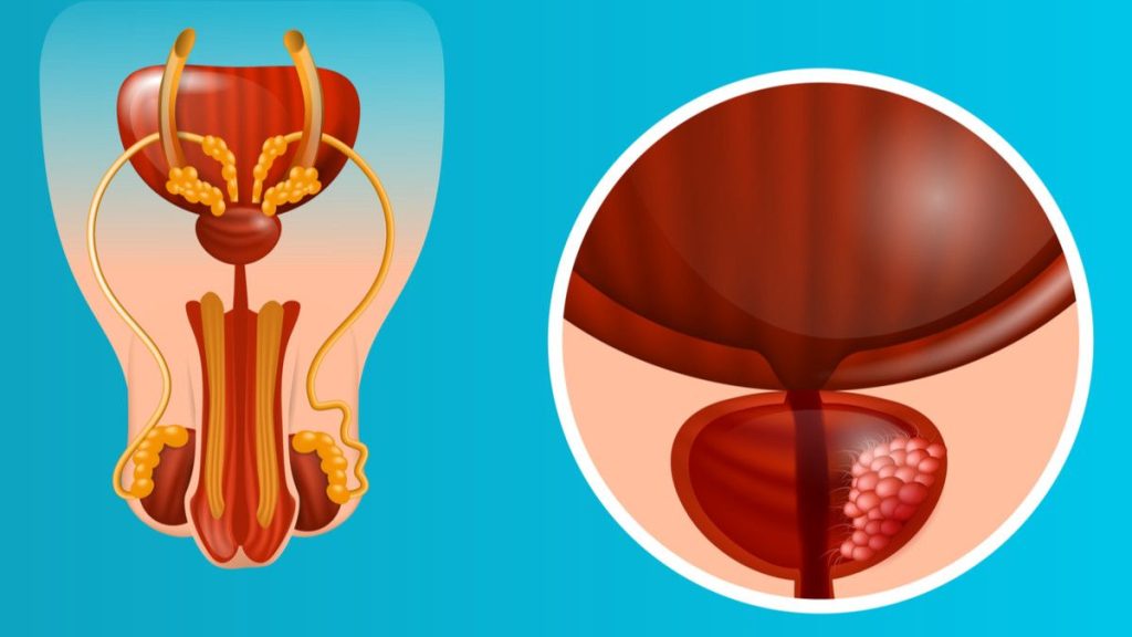 Kanker Prostat: Deteksi Dini dan Harapan Baru | INCA Hospital