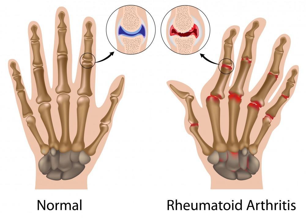 Reumatoid Arthritis