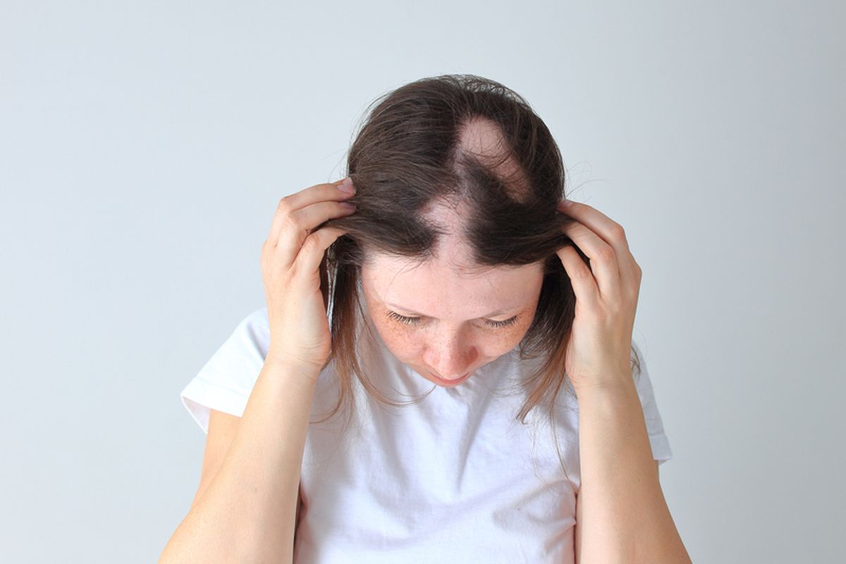 Alopecia Areata